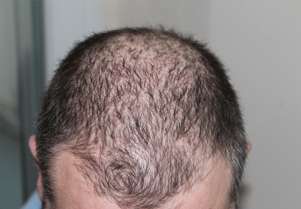 Will Minoxidil Work For Me?